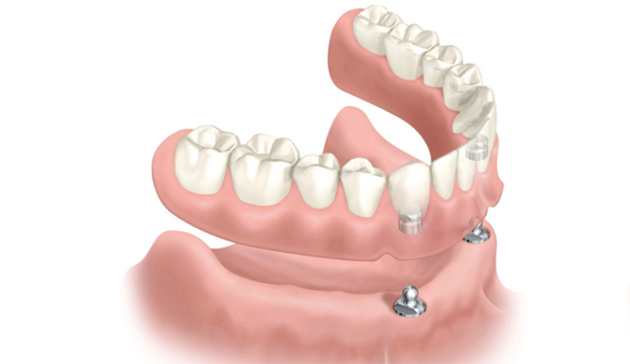Lunch Publicatie Ironisch Tandprothese op implantaten – De Duynen Dental
